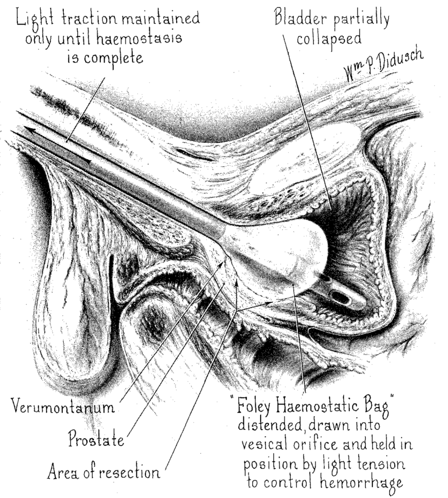 Foley haemostatic bag catheter