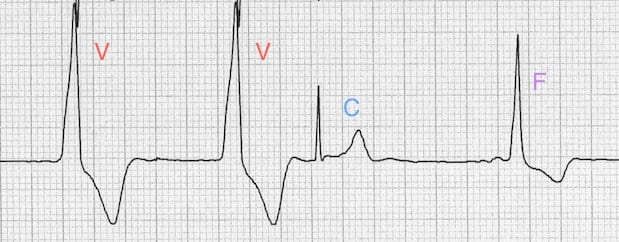 ventricular escape rhythm