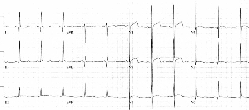 HCM asymmetrical septal hypertrophy ECG