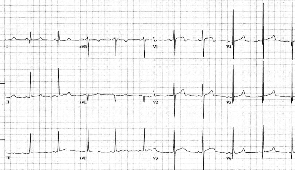 HCM pattern with asymmetrical septal hypertrophy