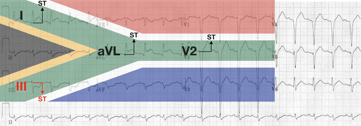 High lateral STEMI South African Flag sign