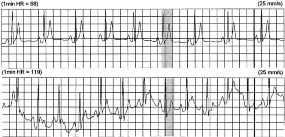 Short QT Syndrome • LITFL • ECG Library Diagnosis