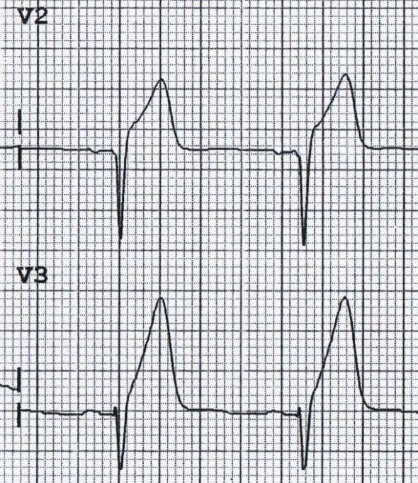 Hyperacute T waves due to anterior STEMI