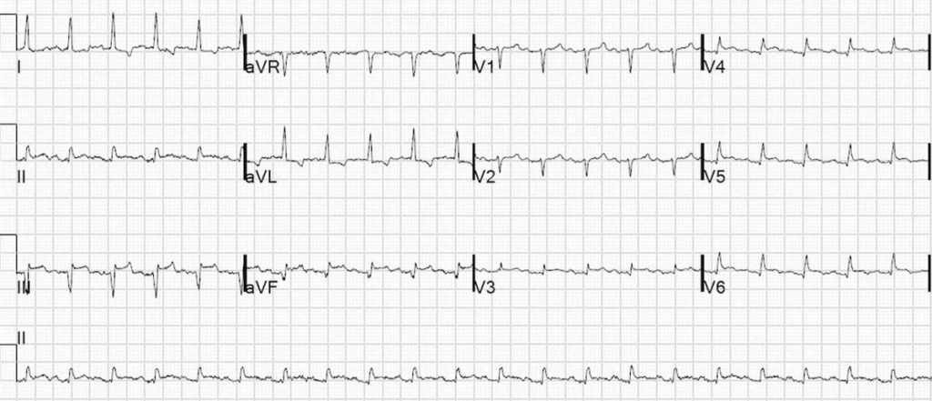 Inferior Left Ventricular Aneurysm 2