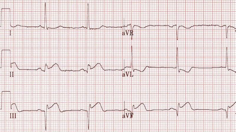 Q Wave LITFL ECG Library Basics Q Wave LITFL ECG Library Basics