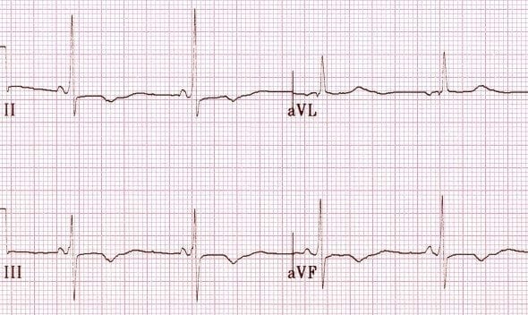 The T-Wave Explained - What Do T Waves On An ECG Represent?