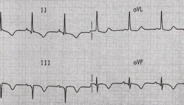 types-of-t-wave-morphologies-cardiology-medstudent-grepmed