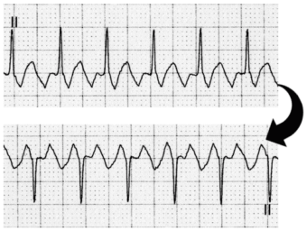 Inverted A Flutter ECG Case 042 • LITFL • ECG Top 100 Self-Assessment Quiz