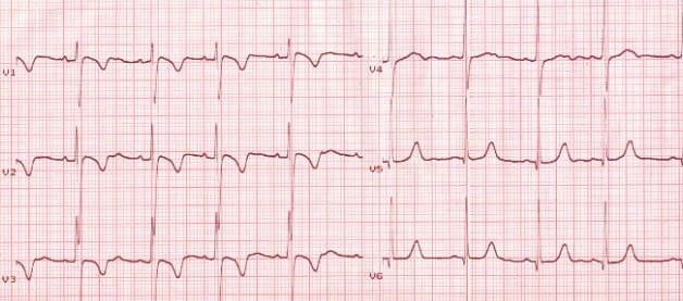 what does a t wave inversion look like