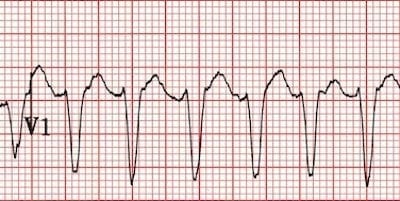 VT versus SVT • LITFL Medical Blog • ECG Library Basics