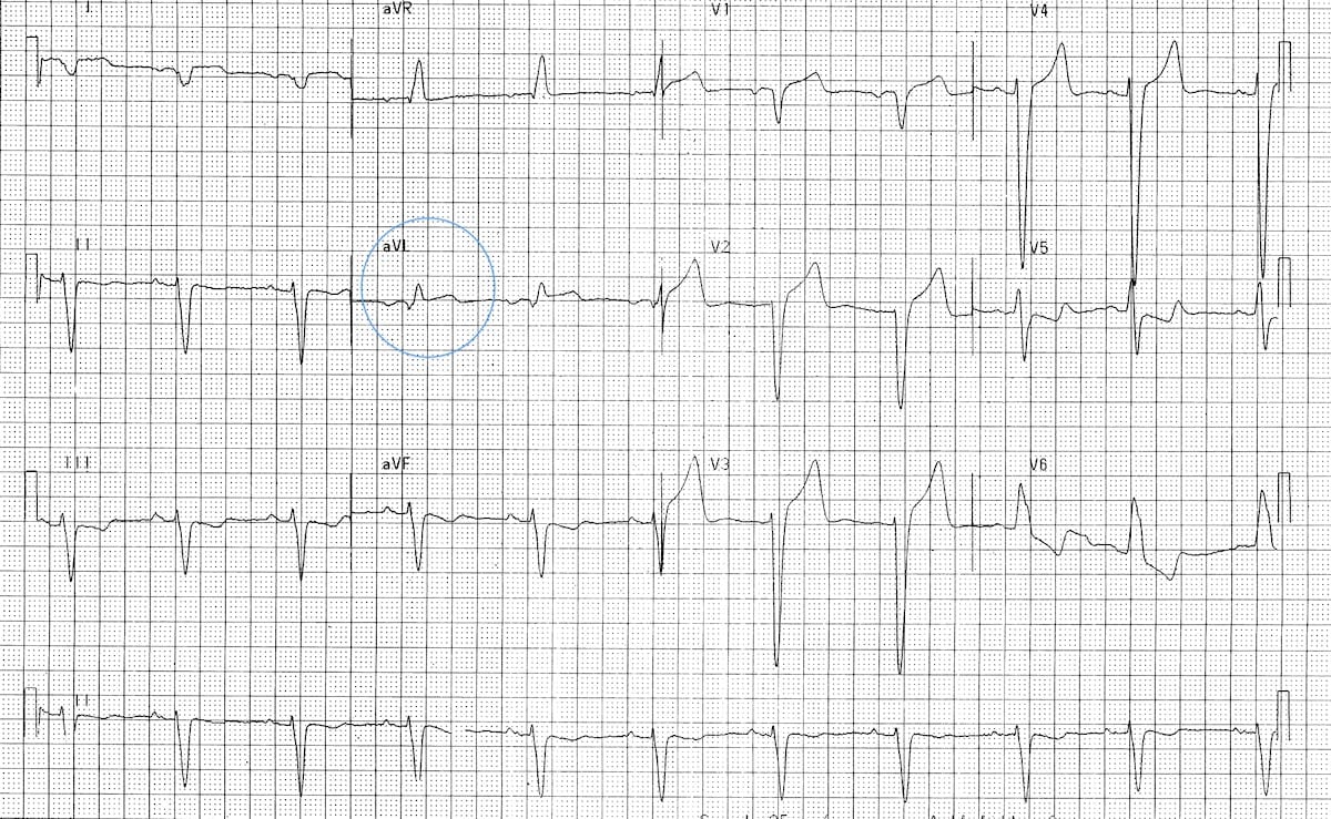 Ecg Litfl Diagnosis Sinus Ekg Ventricular Bifascicular Myocardial ...