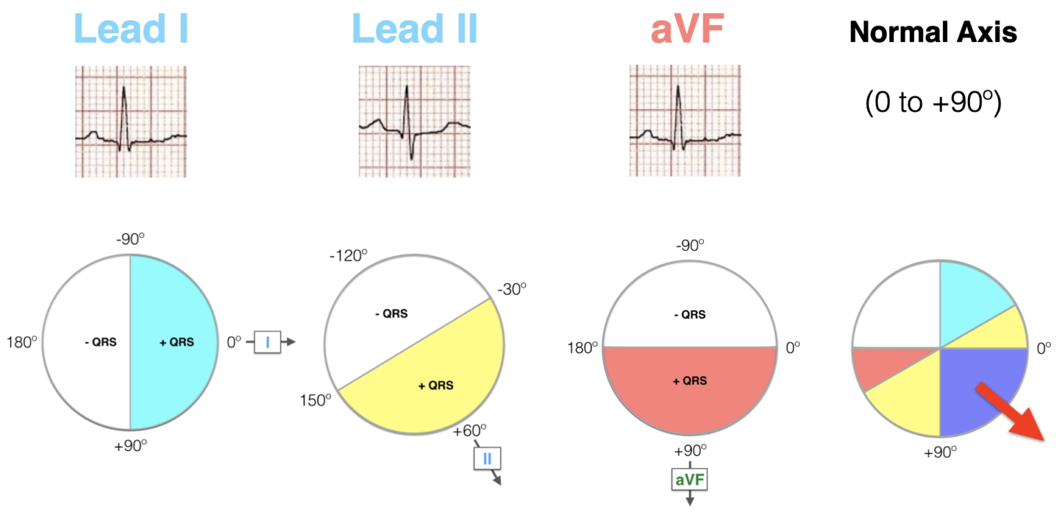ECG Axis Interpretation LITFL ECG Library Basics