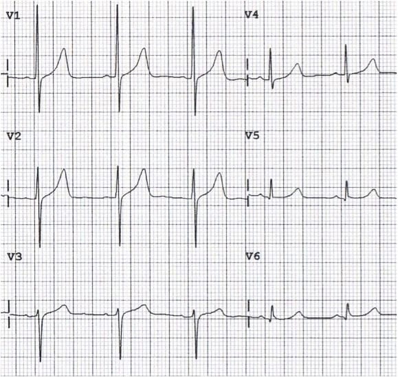 Poor R Wave Progression Prwp Litfl Ecg Library Diagnosis