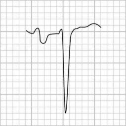 P wave • LITFL • ECG Library Basics