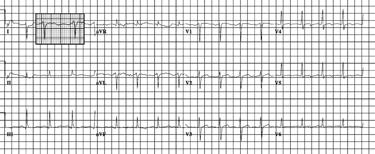 Left Posterior Fascicular Block Lpfb Litfl Ecg Library Diagnosis