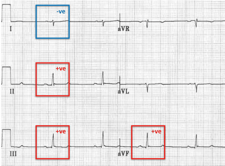 Right Axis Deviation RAD LITFL ECG Library Diagnosis