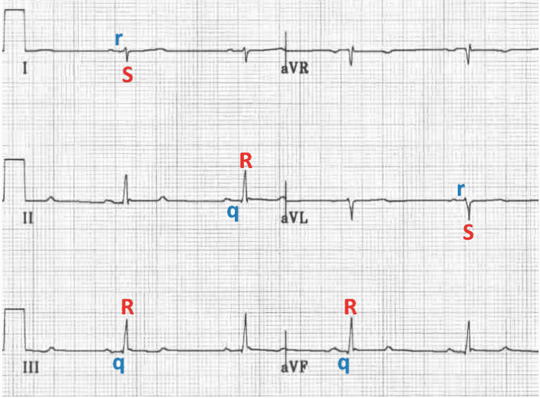 Left Posterior Fascicular Block (LPFB) • LITFL • ECG Library Diagnosis