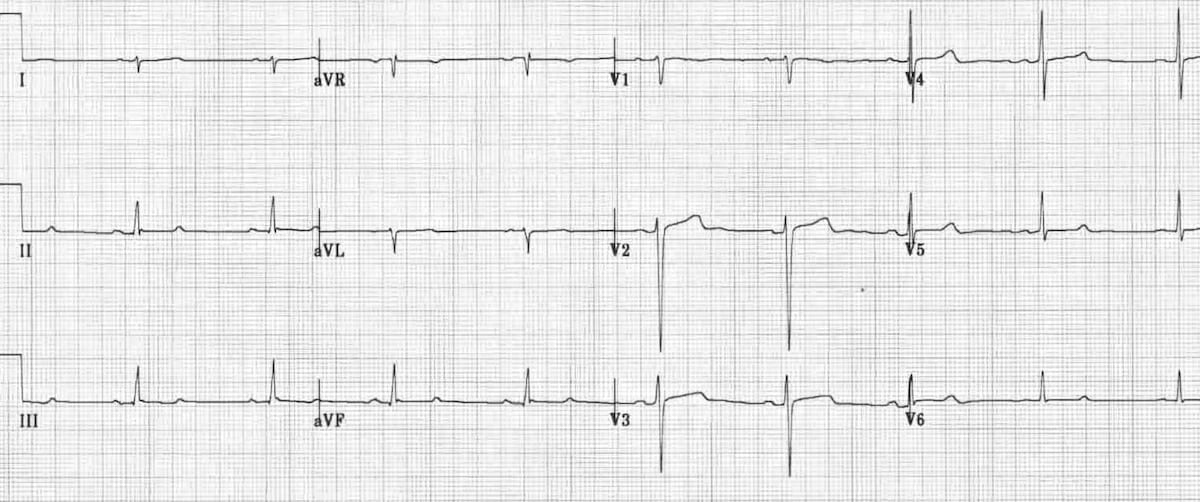 Left Posterior Fascicular Block Lpfb Litfl Ecg Library Diagnosis