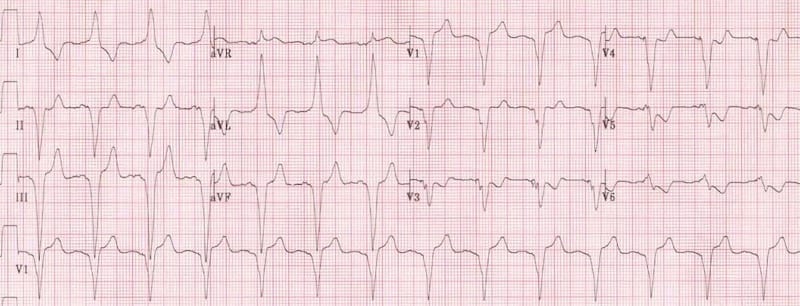 what does a t wave inversion look like