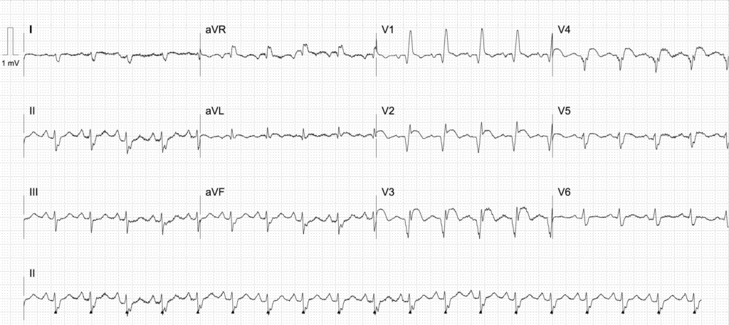 Left ventricular aneurysm 2022 17 02