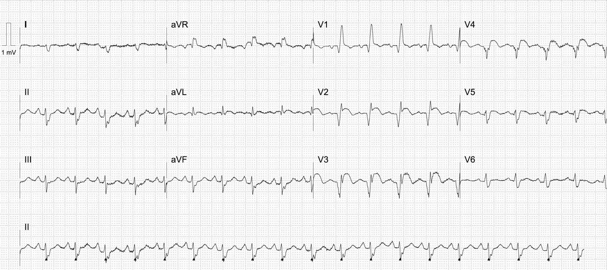 Left Ventricular Aneurysm • LITFL • ECG Library Diagnosis