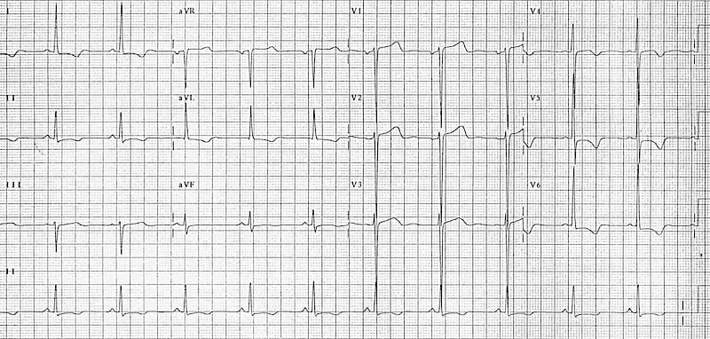 Left ventricular hypertrophy with T-wave inversion