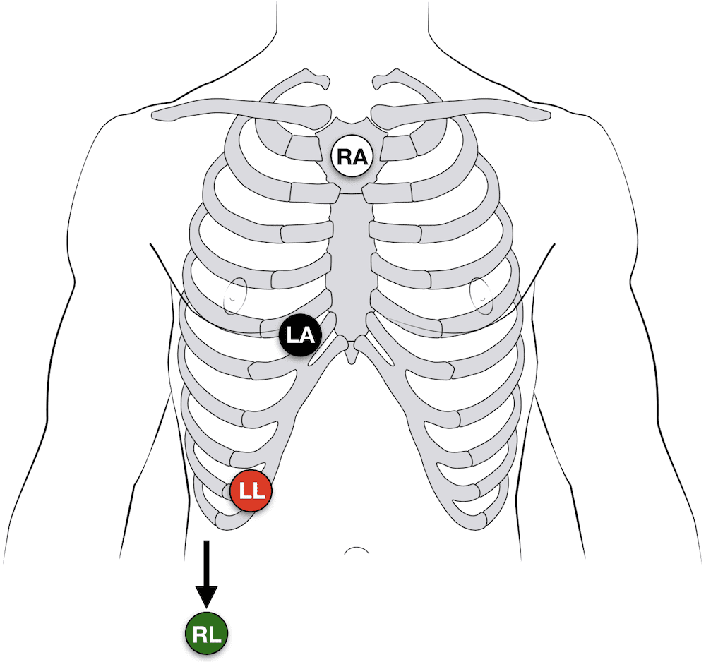 Ecg Placement Chart