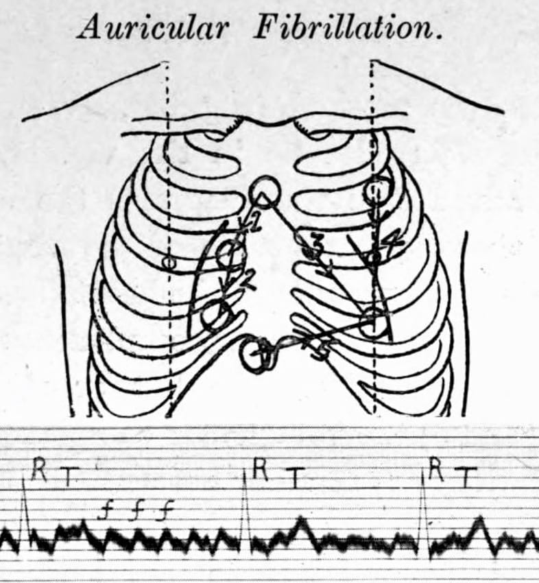 ECG Lead positioning • LITFL • ECG Library Basics