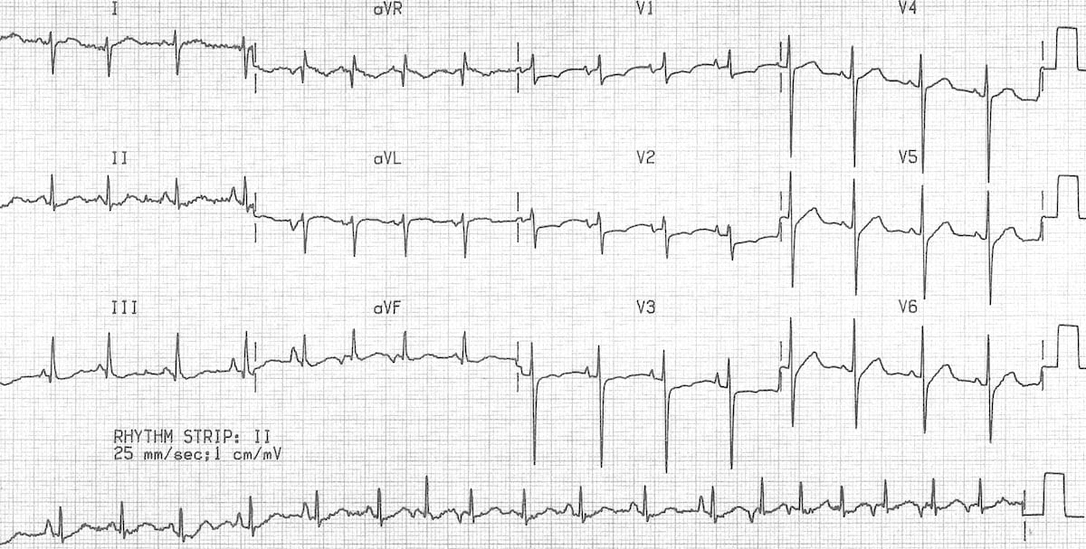 Patient ECG showing extreme counterclockwise rotation of the heart