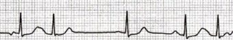P wave • LITFL • ECG Library Basics