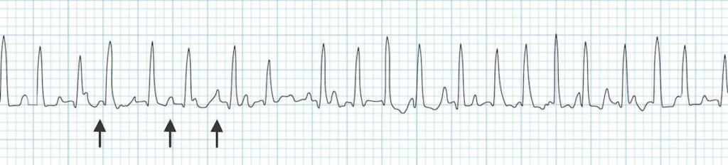 Multifocal Atrial Tachycardia (MAT)