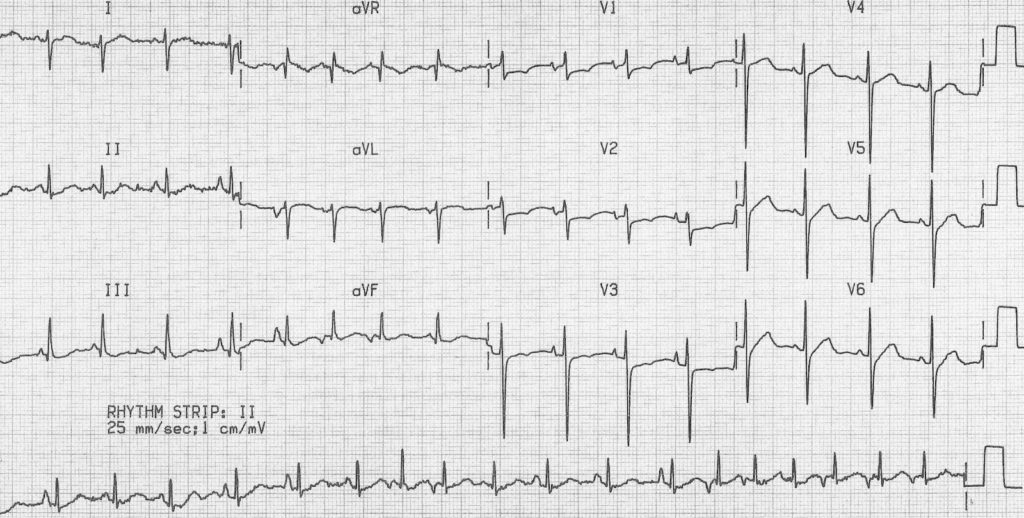 Multifocal Atrial Tachycardia (MAT) COPD 2