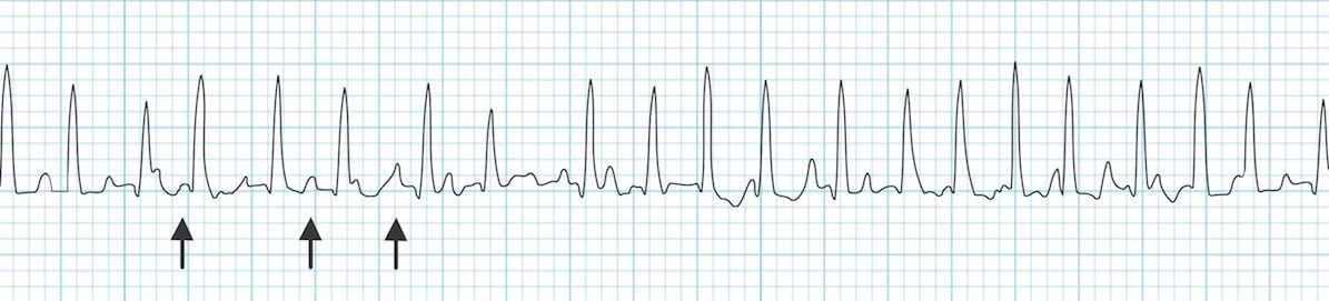 Multifocal Atrial Tachycardia (MAT) • LITFL • ECG Library Diagnosis