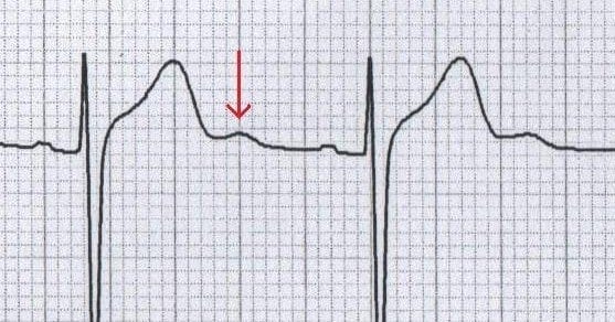 U Wave • LITFL Medical Blog • ECG Library Basics