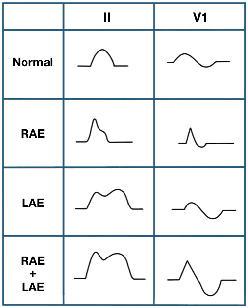 P wave • LITFL • ECG Library Basics