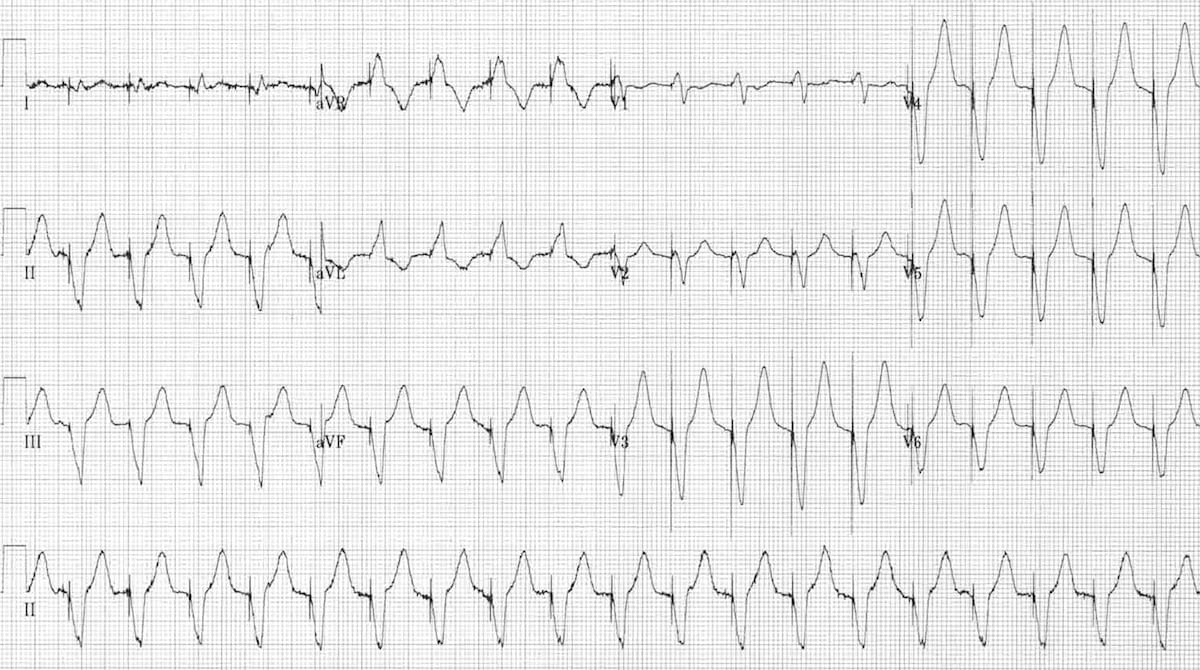 Pacemaker Malfunction Litfl Ecg Library Diagnosis