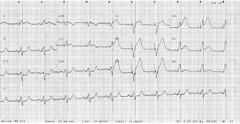 Sgarbossa Criteria • LITFL • ECG Library Diagnosis