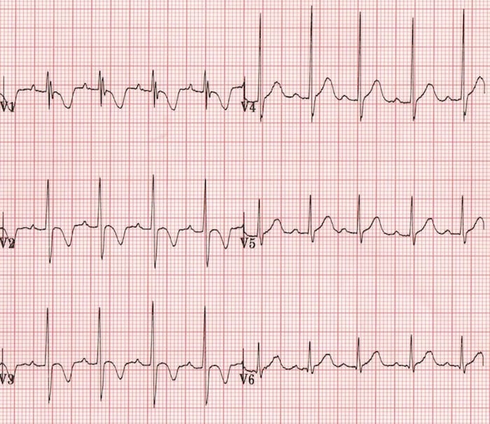 T wave • LITFL • ECG Library Basics