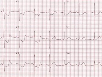 R wave • LITFL • ECG Library Basics