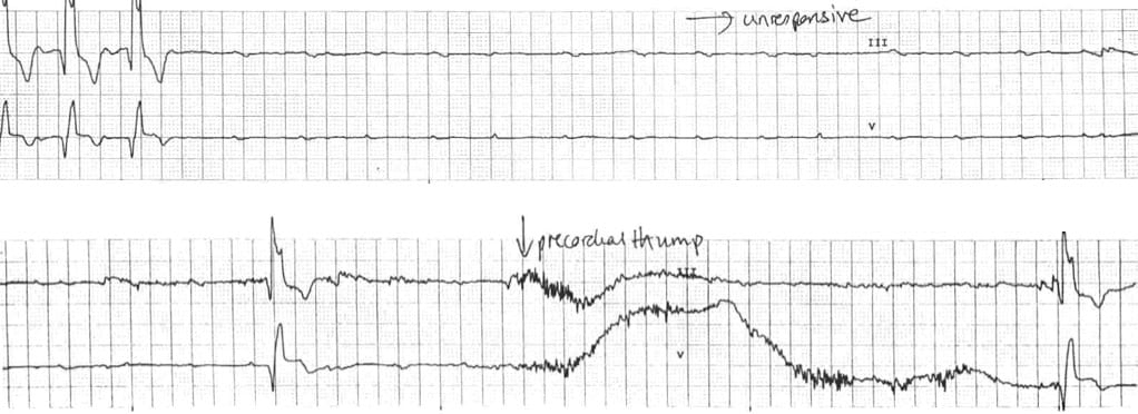 Guide To Understanding ECG Artifact ACLS Medical Training, 53% OFF