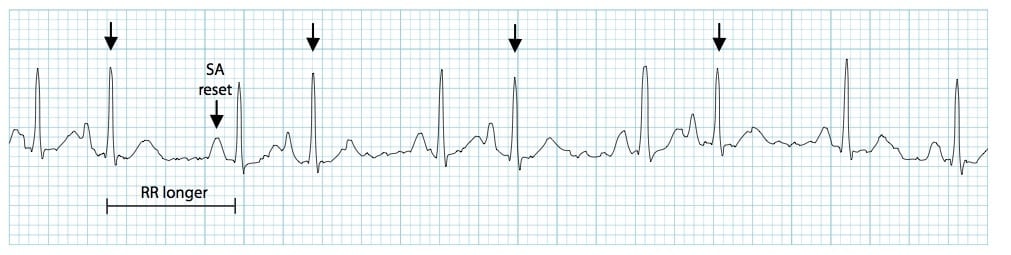 premature atrial contractions vs premature ventricular contractions