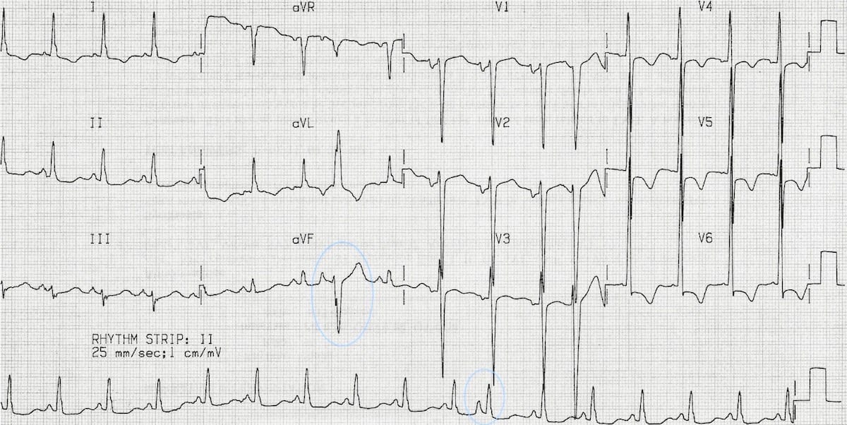 premature atrial complex