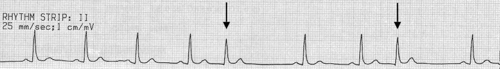 Premature Junctional Complex Pjc Litfl Ecg Library Diagnosis