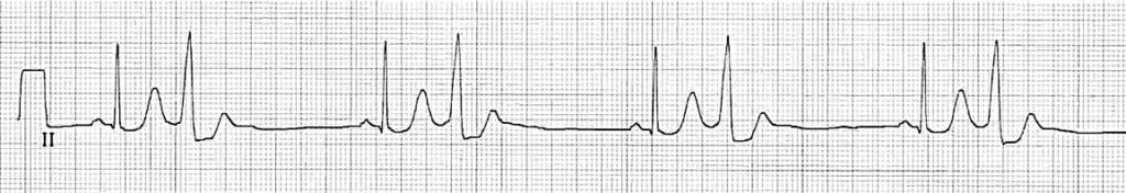 Premature Ventricular Complex (PVC) bigeminy