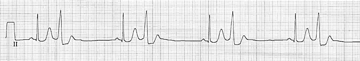 Premature Ventricular Complex (PVC) • LITFL • ECG Library Diagnosis