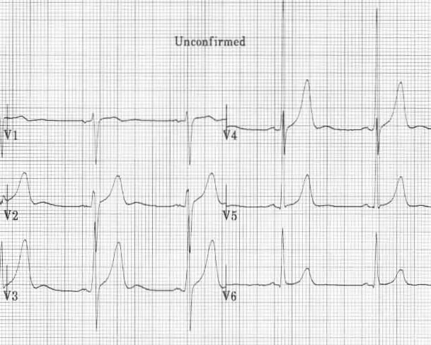 U Wave • LITFL Medical Blog • ECG Library Basics