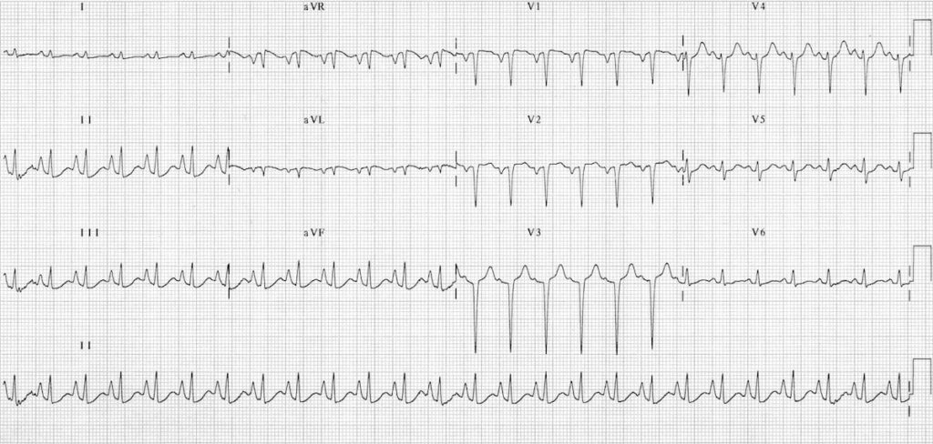 Pulmonary disease pattern COPD ECG