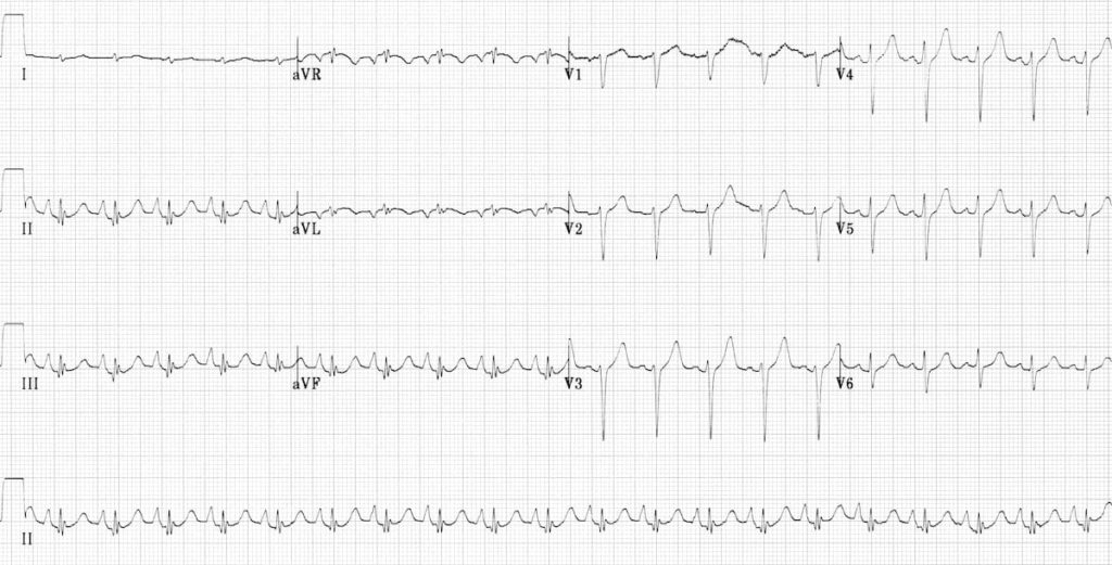 Pulmonary disease pattern COPD ECG 2