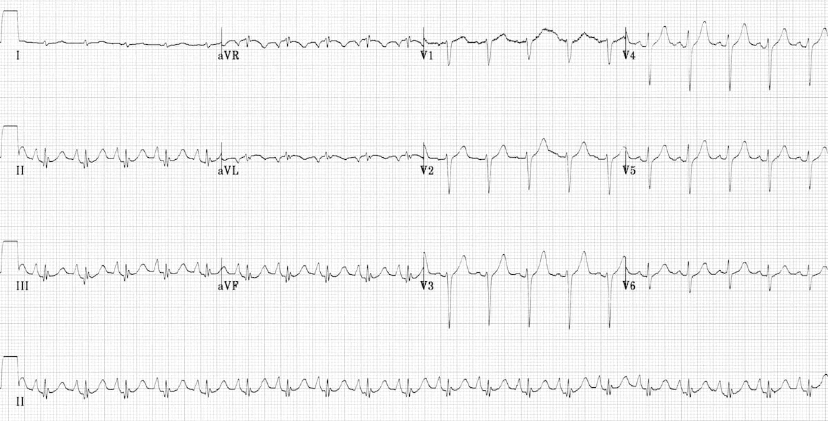 ECG in Chronic Obstructive Pulmonary Disease • LITFL • ECG Library