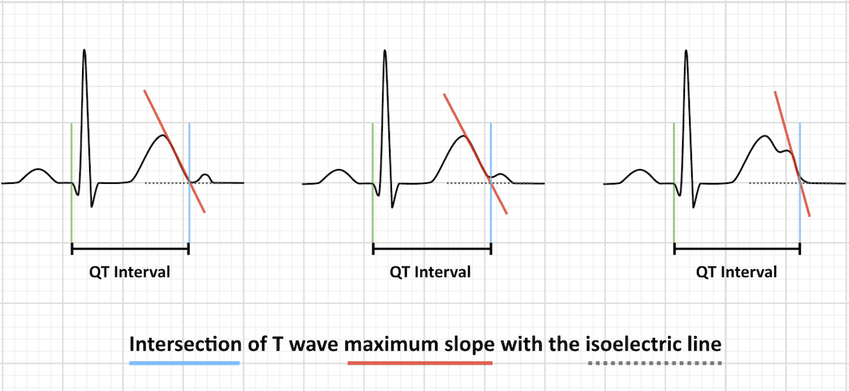 qtc normal range